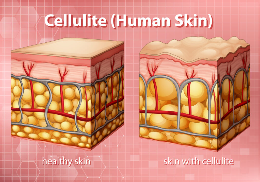 Diagram showing cellulite and why cellulite treatment in human skin illustration